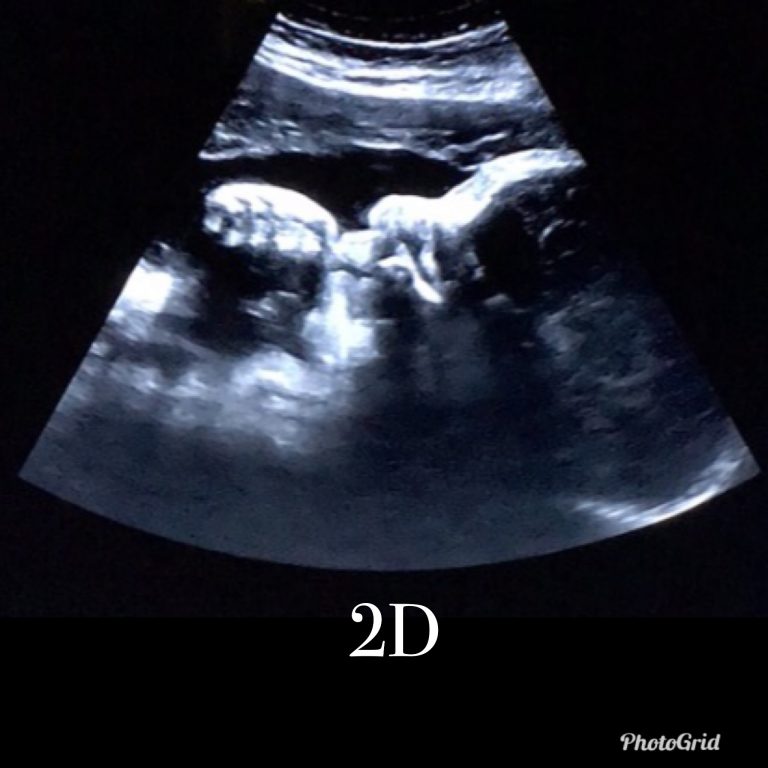 treasured moments 4d ultrasound